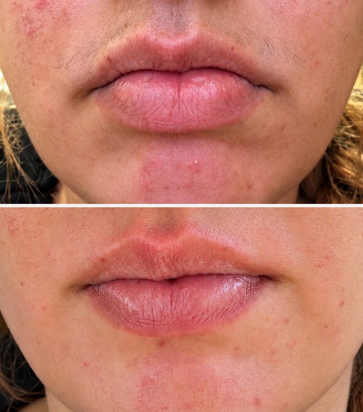 Before and after view of a client’s lip-area waxing result at Bare Haven Wax Studio
